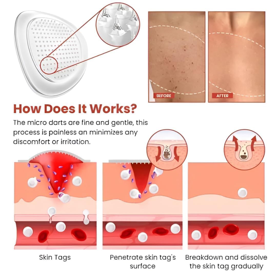 DermaSmooth Skin Tag Removal Patch (BUY 1 GET 1 FREE)