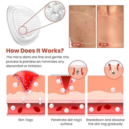 DermaSmooth Skin Tag Removal Patch (BUY 1 GET 1 FREE)